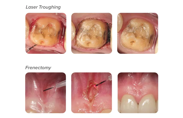 Dental Laser