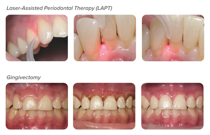 Common Laser Procedures